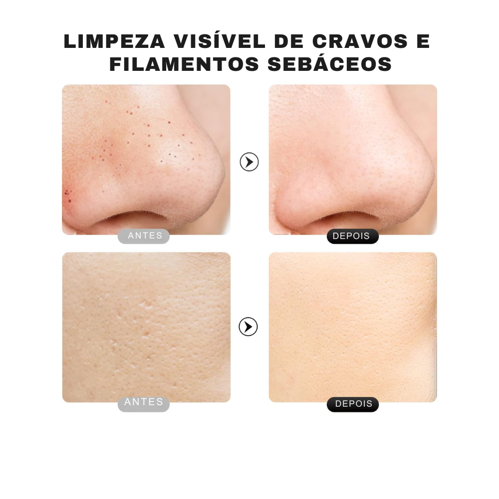 Extrator Ultrassônico com Ions - Removedor de Cravo, Limpeza Profunda dos Poros do Rosto